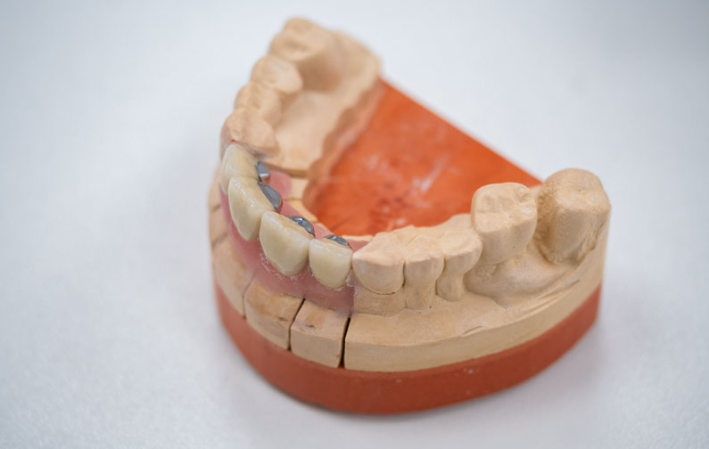 Implant dentaire Corse