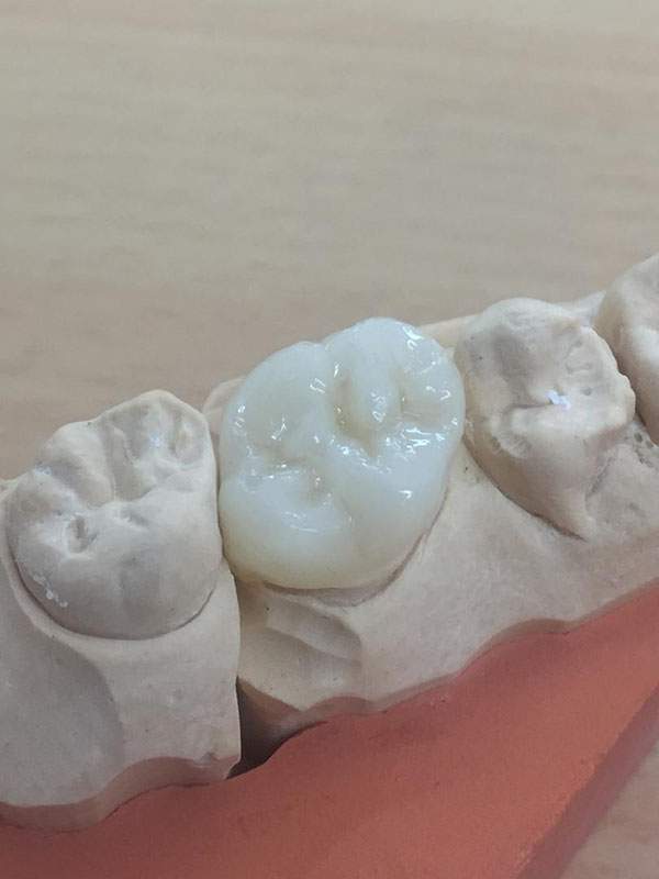Dent céramique sur modèle dentaire de laboratoire Ajaccio