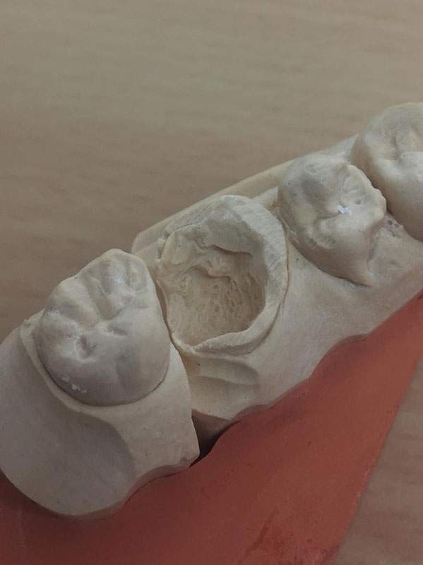Modèle pour moulage dentaire en plâtre Ajaccio