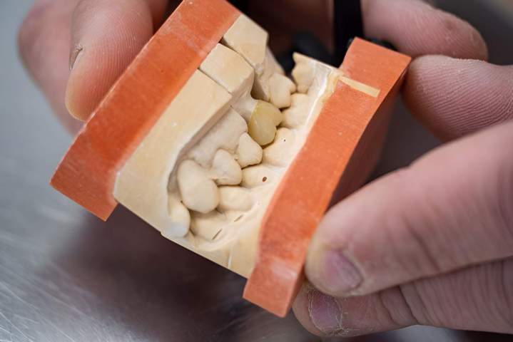Modèle dentaire en plâtre et dent artificielle Ajaccio