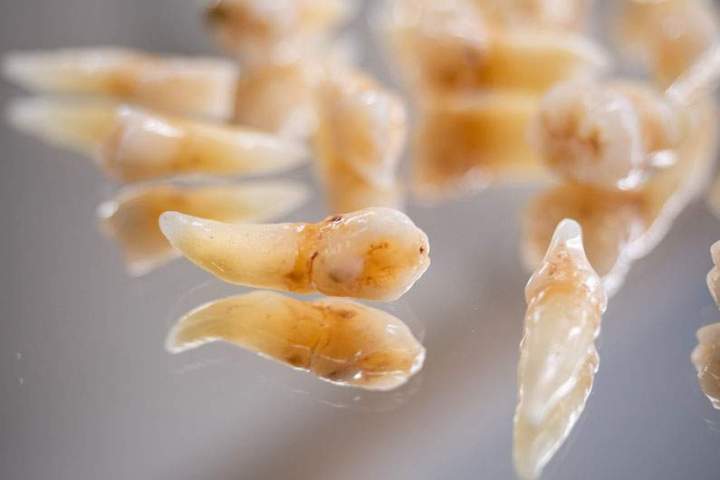 Vraies dents extraites Ajaccio